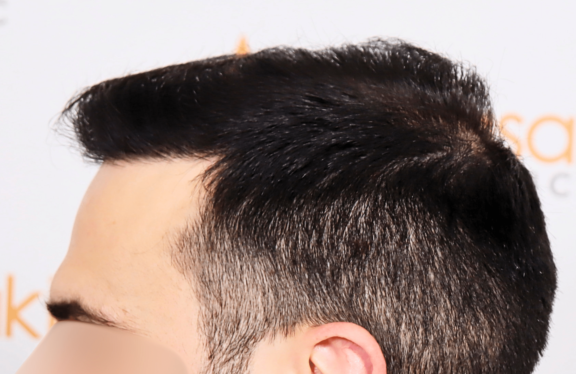 hair transplant result 2500 fus repair stage4