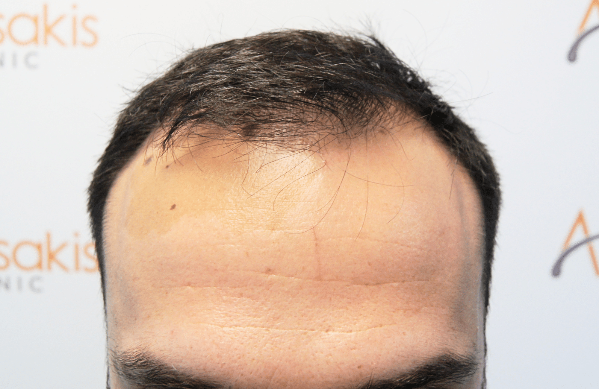 hair transplant result 2500 fus repair stage4