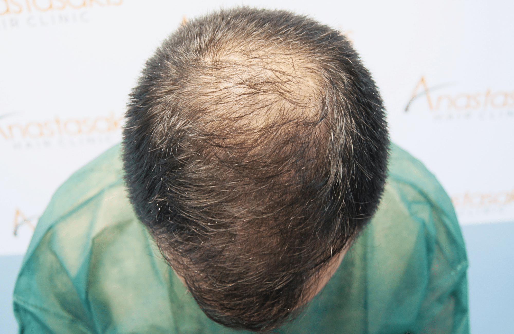 hair transplant result 2500 fus repair stage4