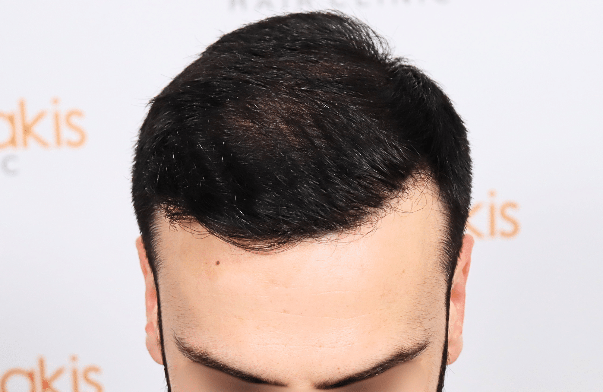 hair transplant result 2500 fus repair stage4