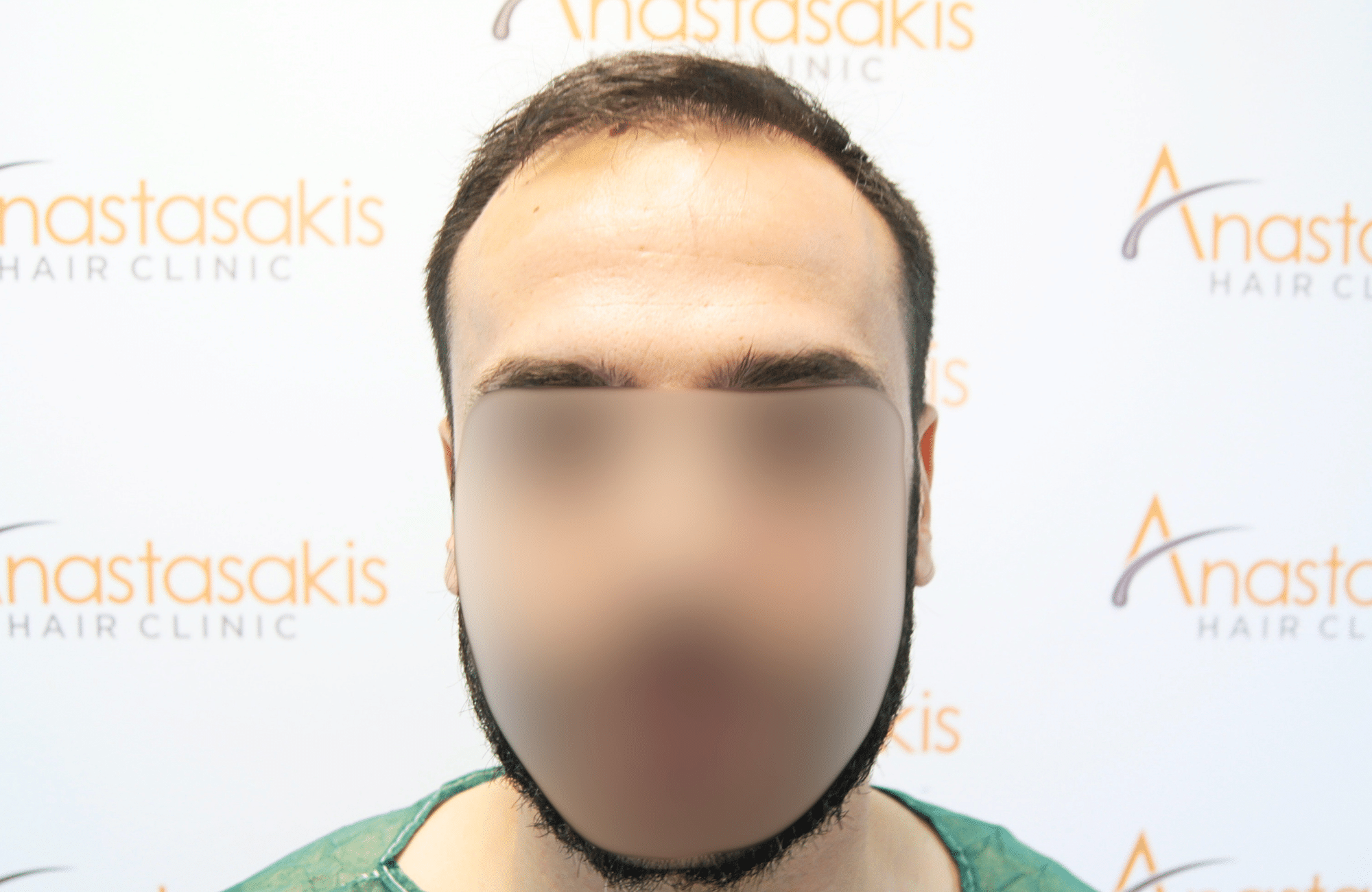 hair transplant result 2500 fus repair stage4