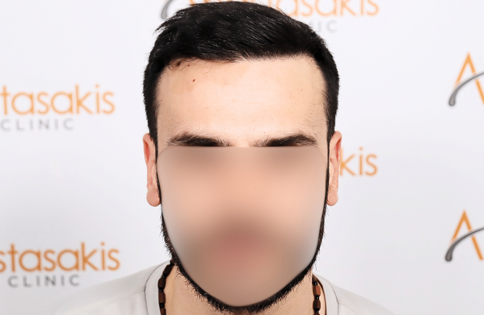 hair transplant result 2500 fus repair stage4