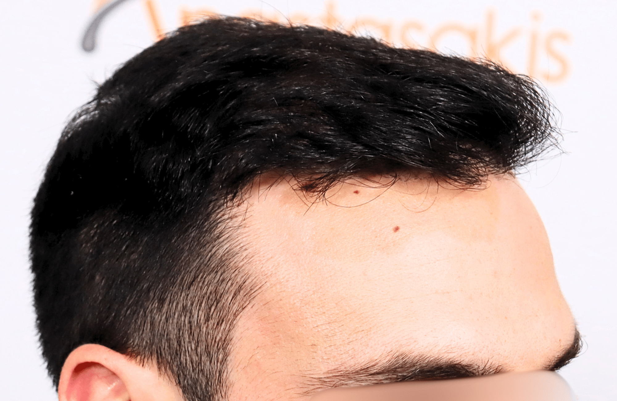 hair transplant result 2500 fus repair stage4