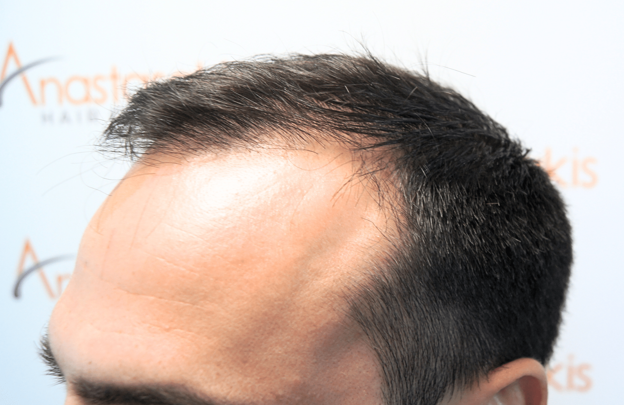 hair transplant result 2500 fus repair stage4