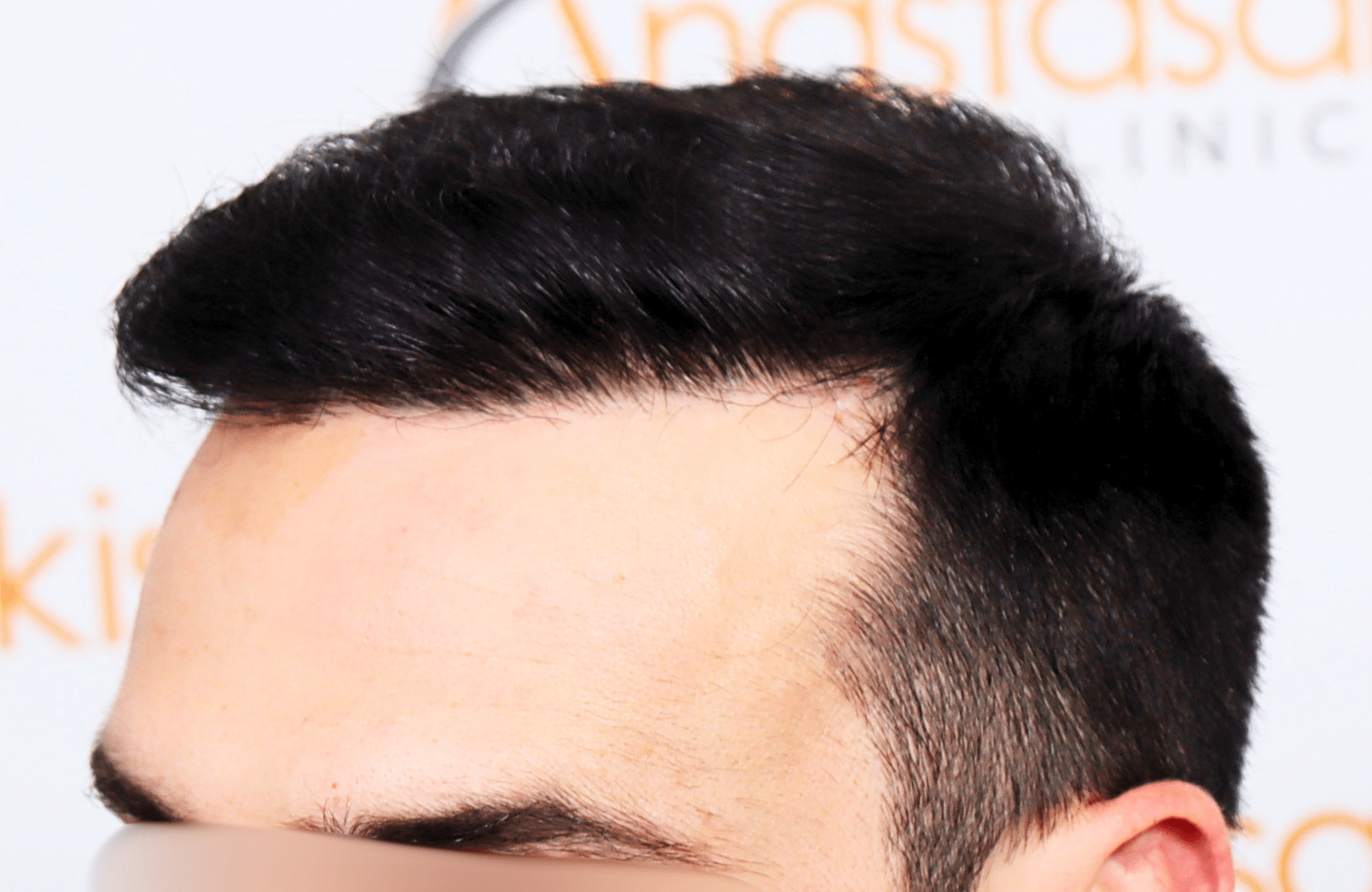 hair transplant result 2500 fus repair stage4