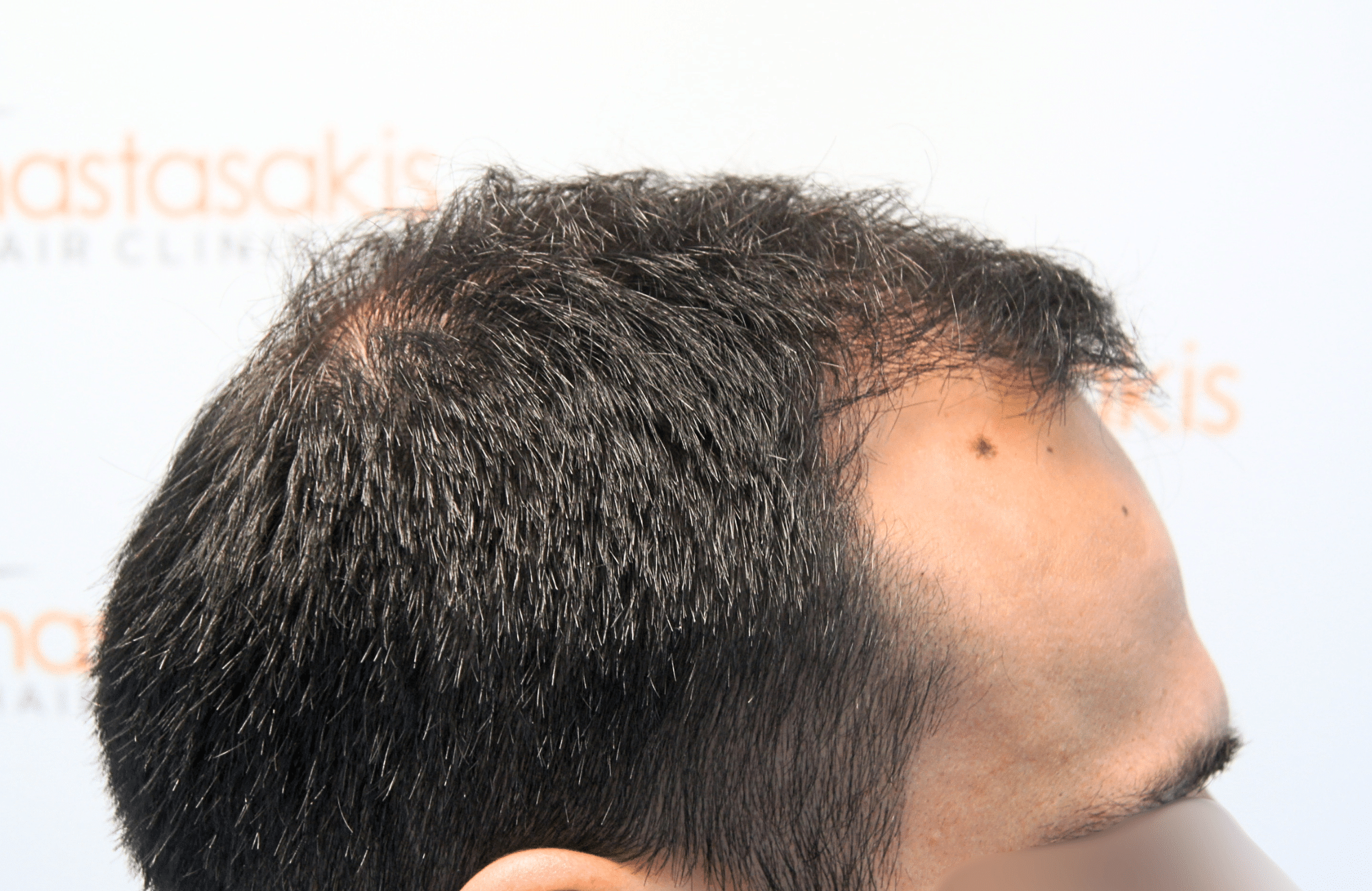 hair transplant result 2500 fus repair stage4
