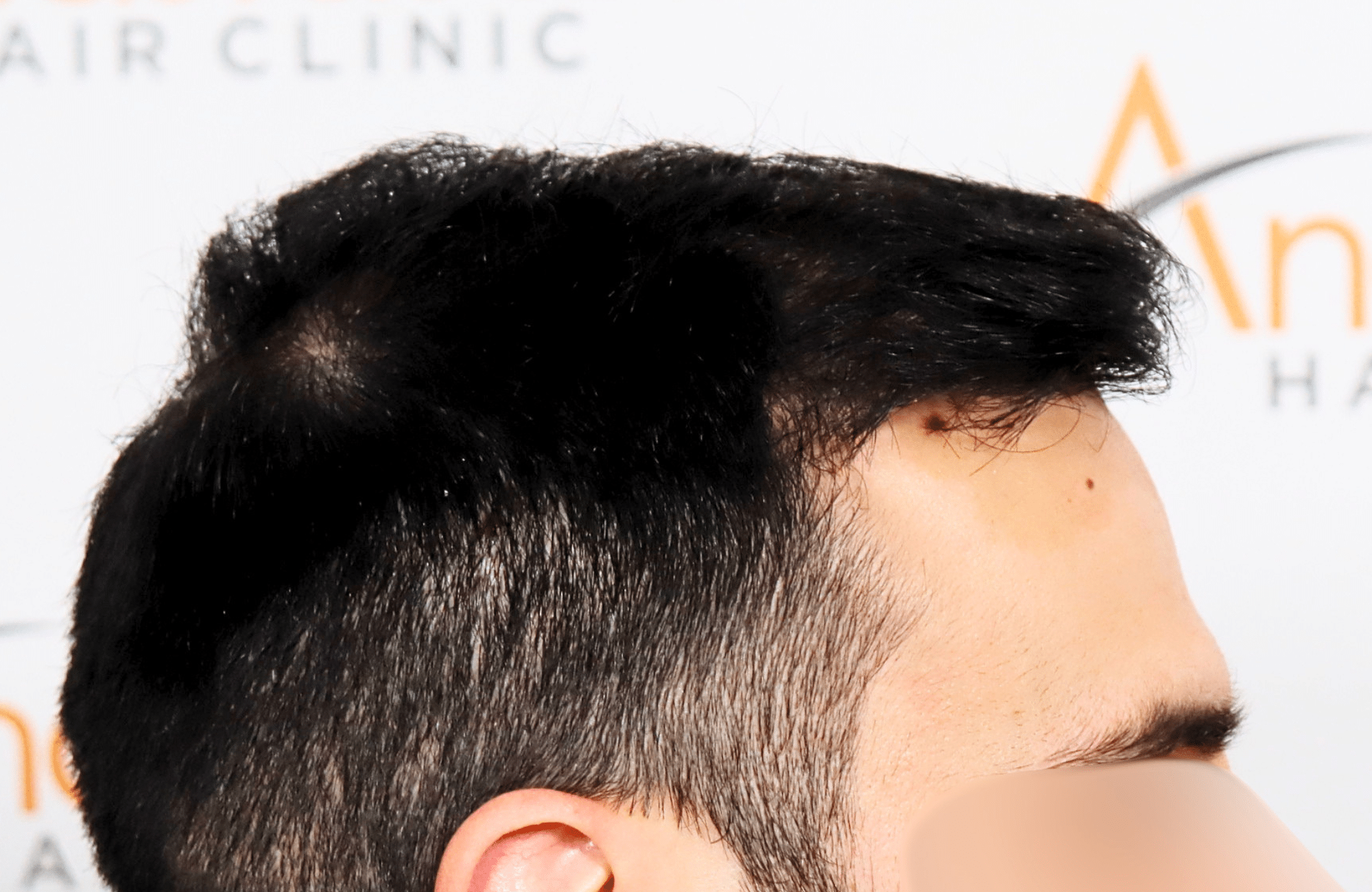 hair transplant result 2500 fus repair stage4