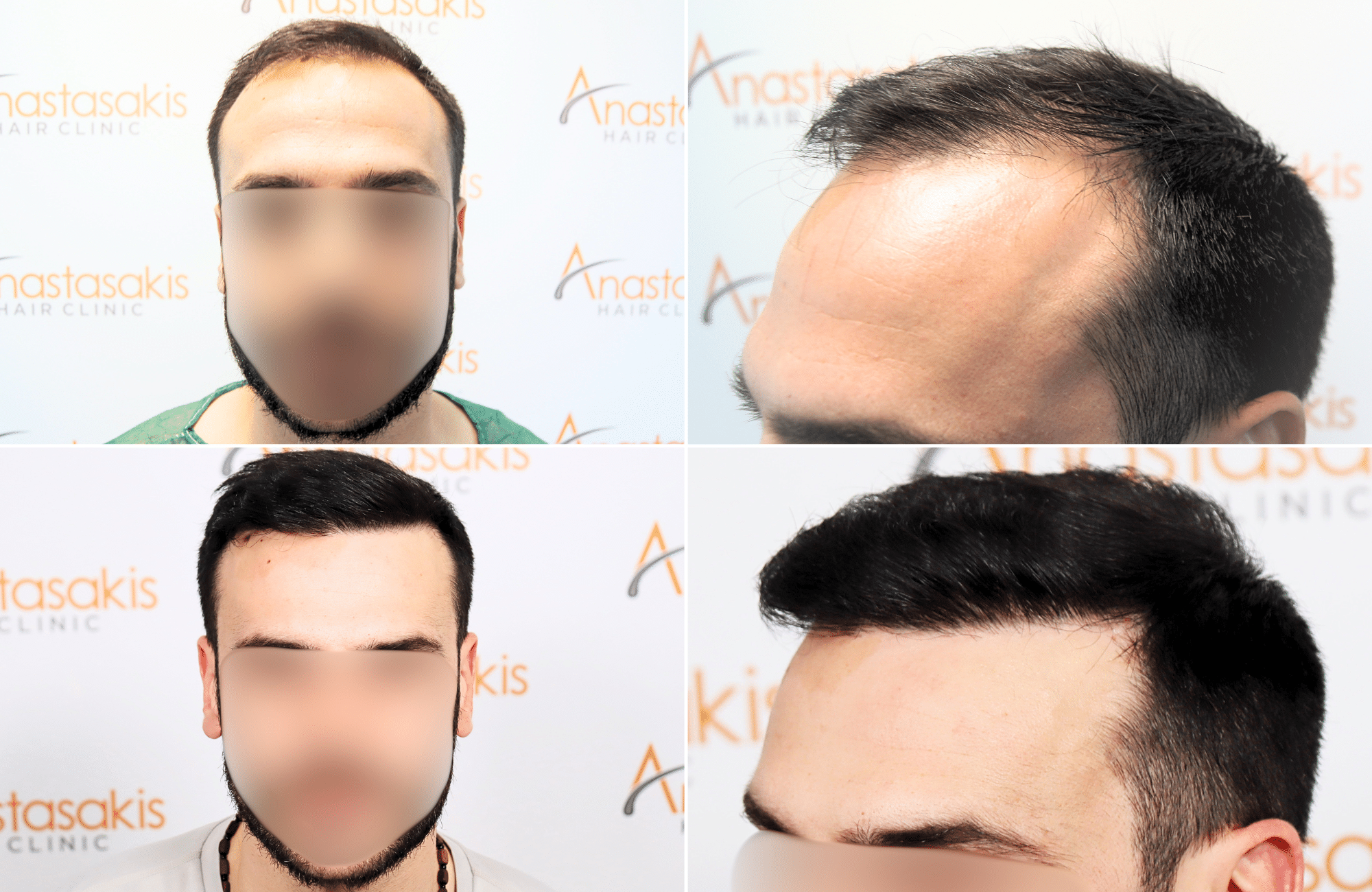 https://www.anastasakishairclinic.gr/portfolio/apotelesma-metamosxefsis-mallion-anastasakis-hair-clinic-605/