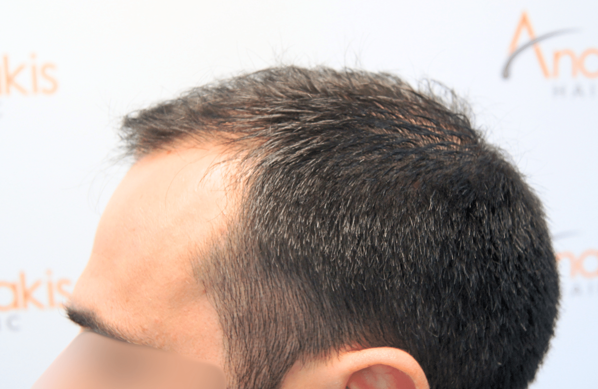 hair transplant result 2500 fus repair stage4