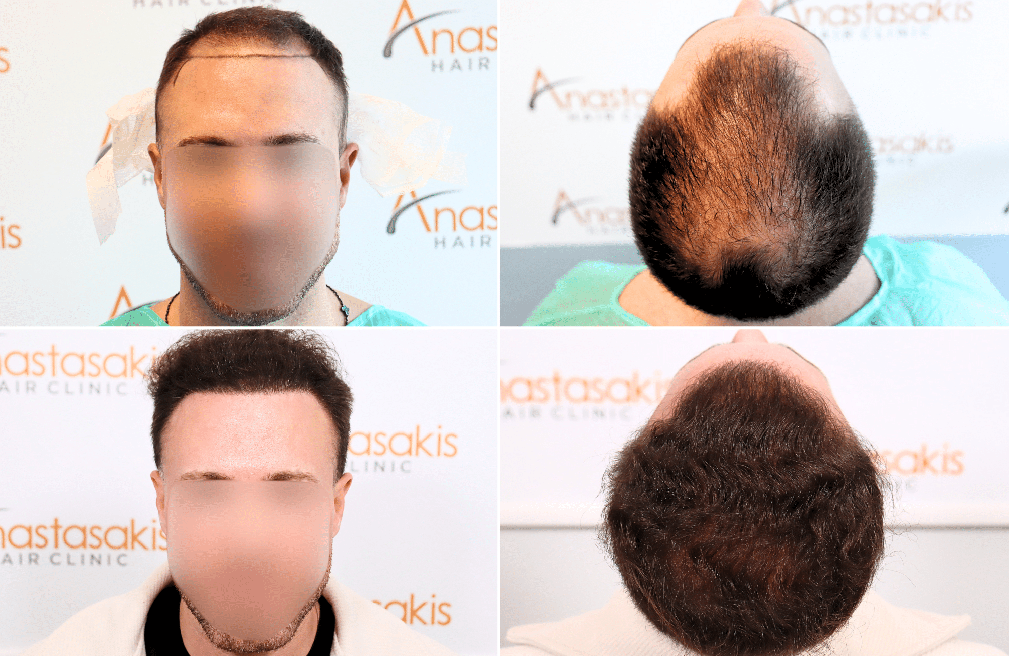 https://www.anastasakishairclinic.gr/portfolio/apotelesma-metamosxefsis-mallion-anastasakis-hair-clinic-327/