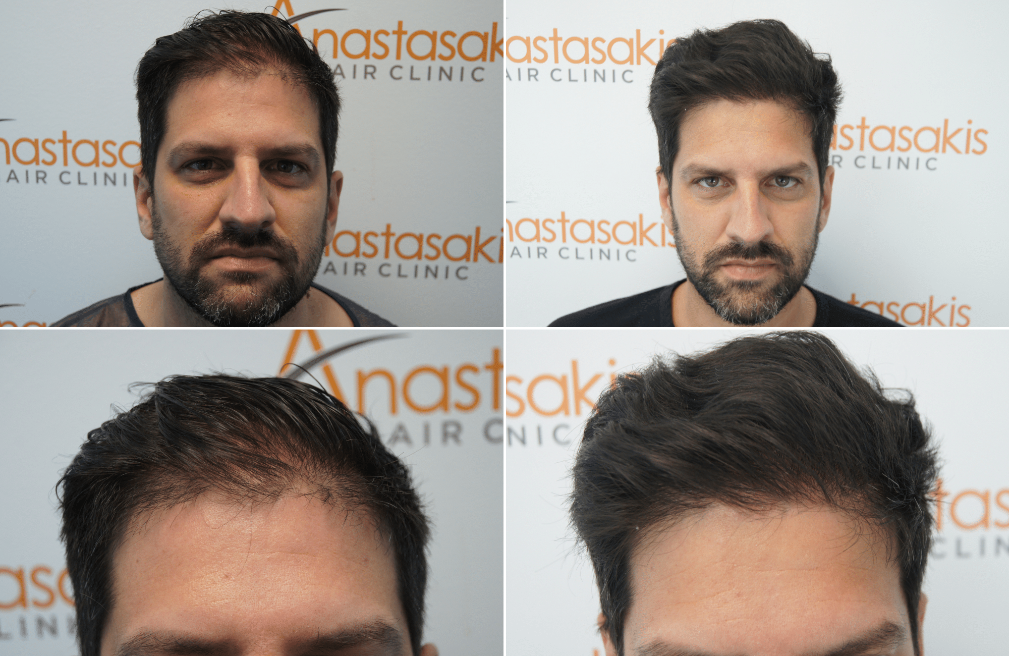 https://www.anastasakishairclinic.gr/portfolio/apotelesma-metamosxefsis-mallion-anastasakis-hair-clinic-324/