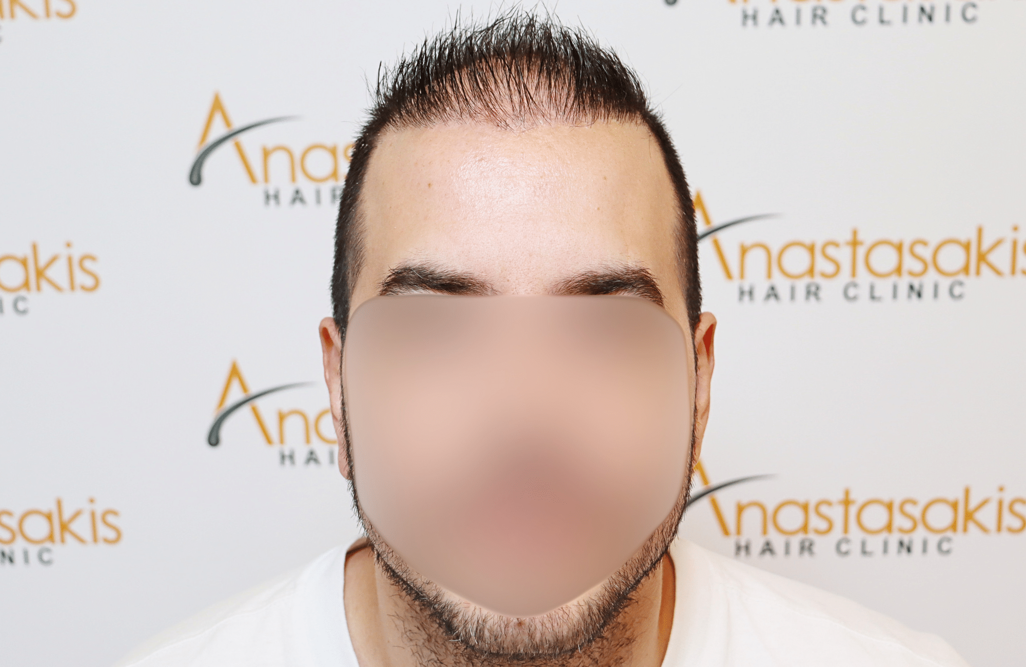 hai transplant result 2400 fus thick diffuse