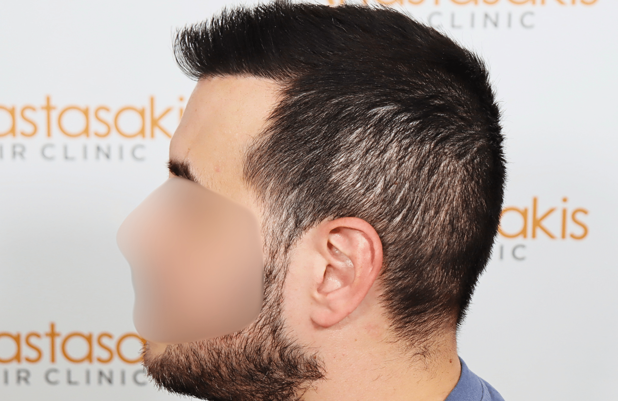 hai transplant result 2400 fus thick diffuse