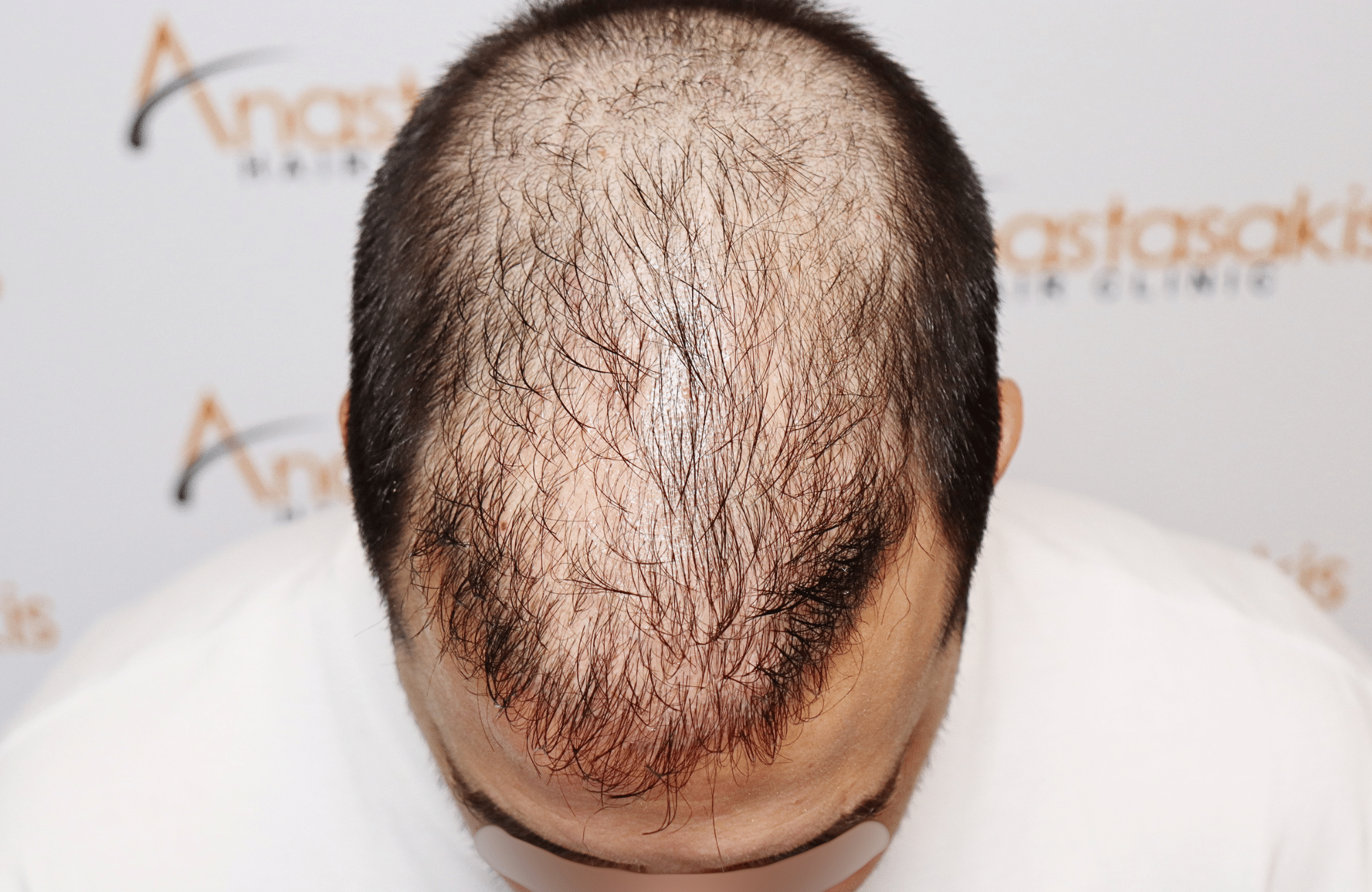 hai transplant result 2400 fus thick diffuse