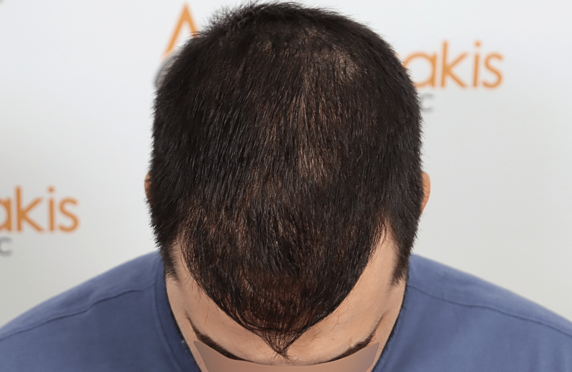 hai transplant result 2400 fus thick diffuse