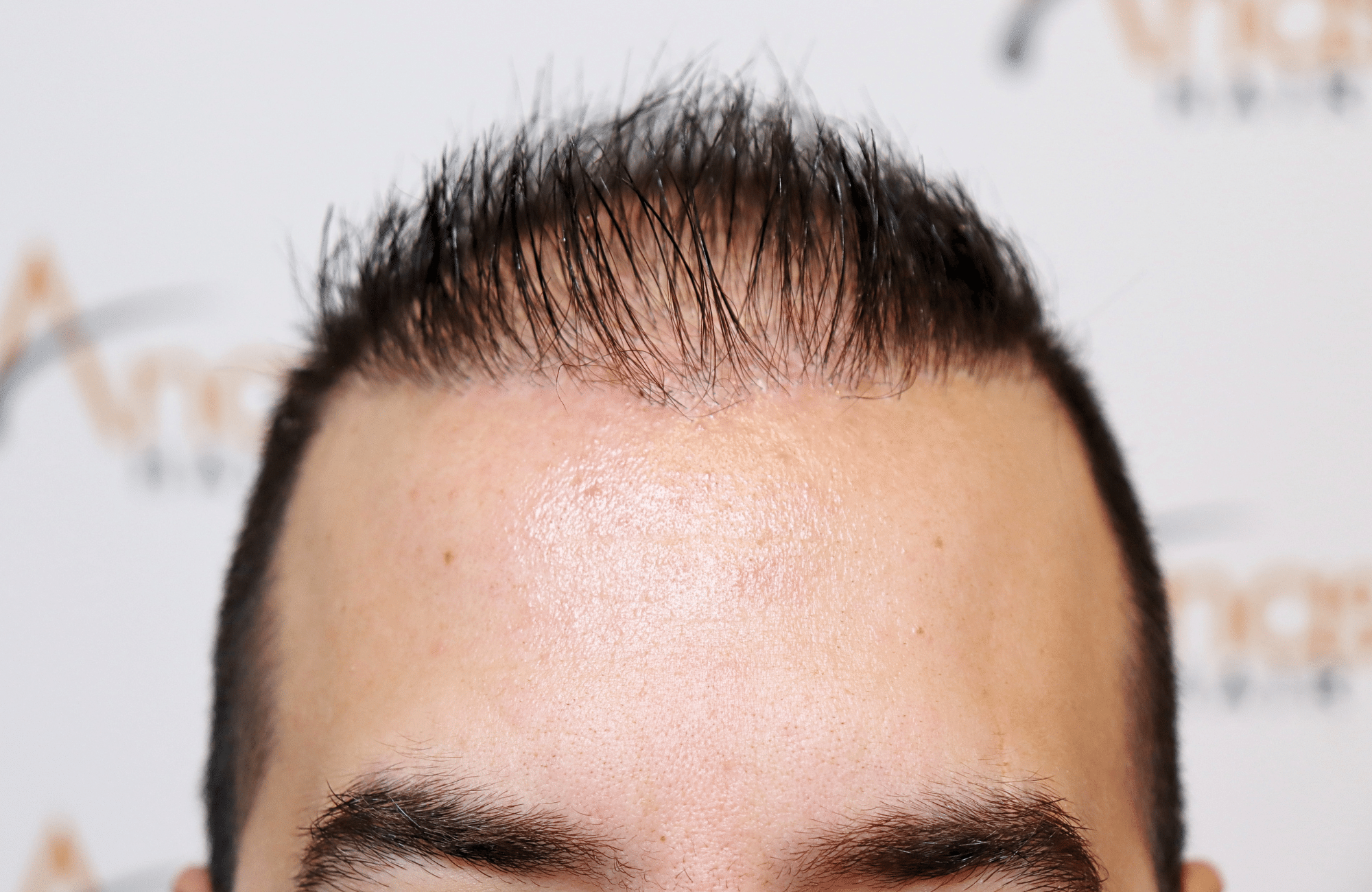 hai transplant result 2400 fus thick diffuse