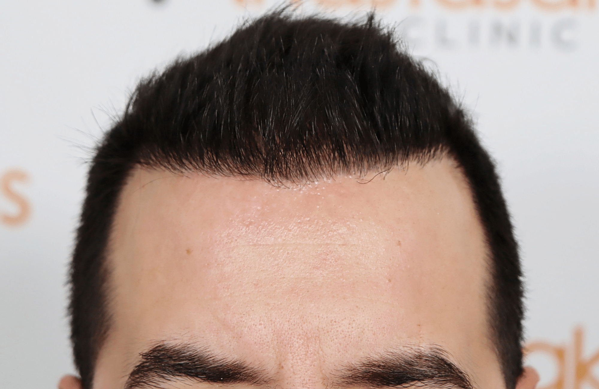 hai transplant result 2400 fus thick diffuse