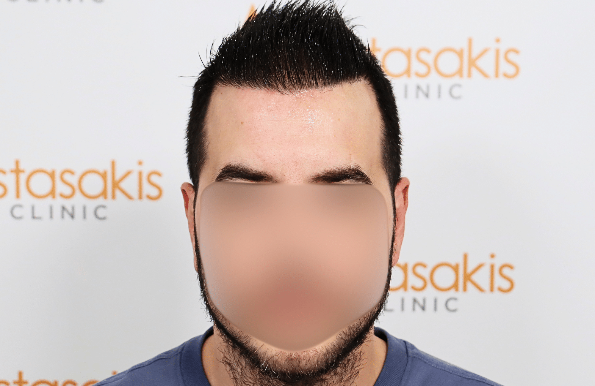 hai transplant result 2400 fus thick diffuse