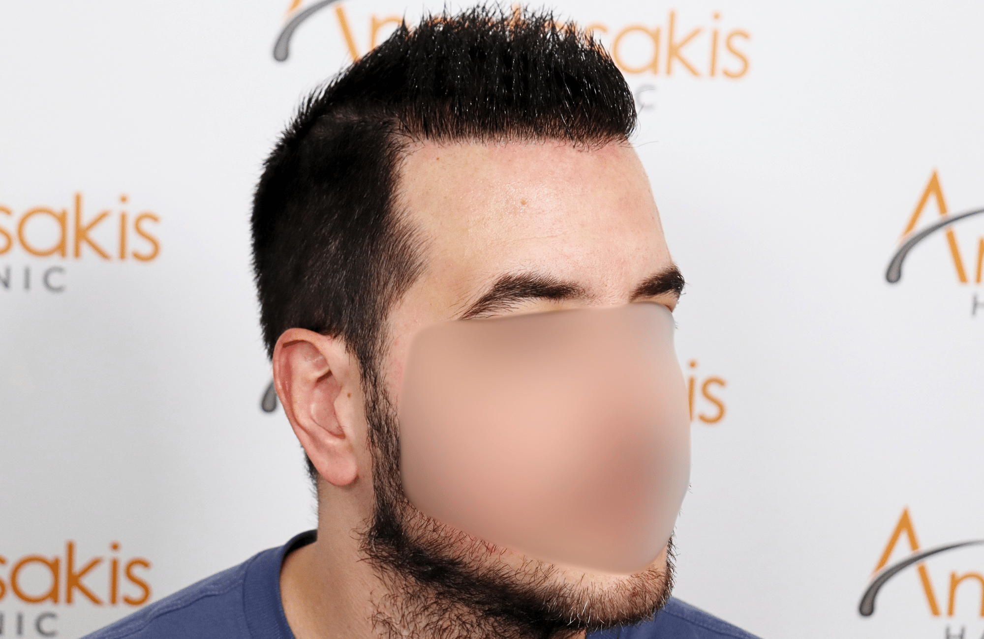 hai transplant result 2400 fus thick diffuse