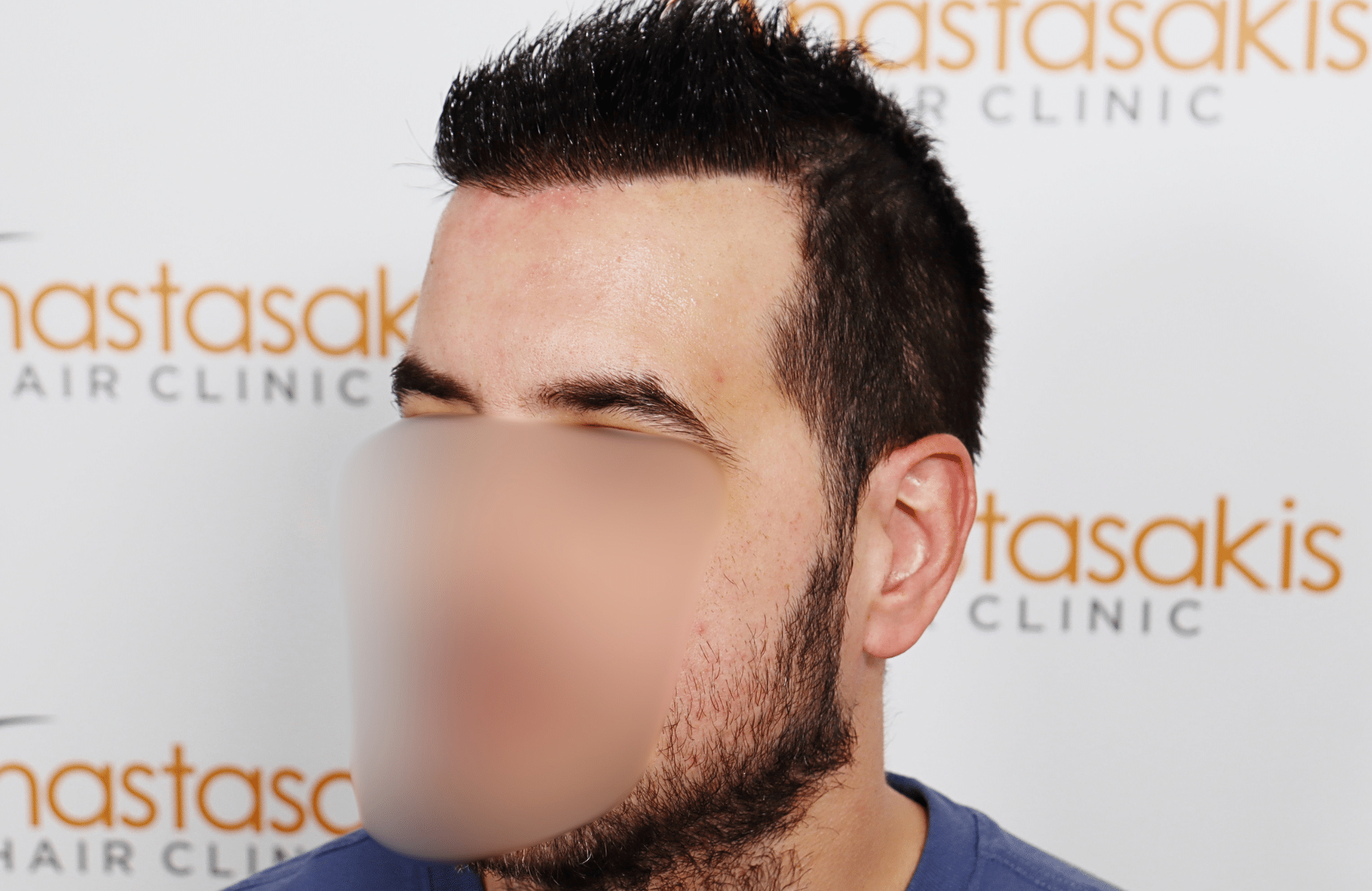 hai transplant result 2400 fus thick diffuse