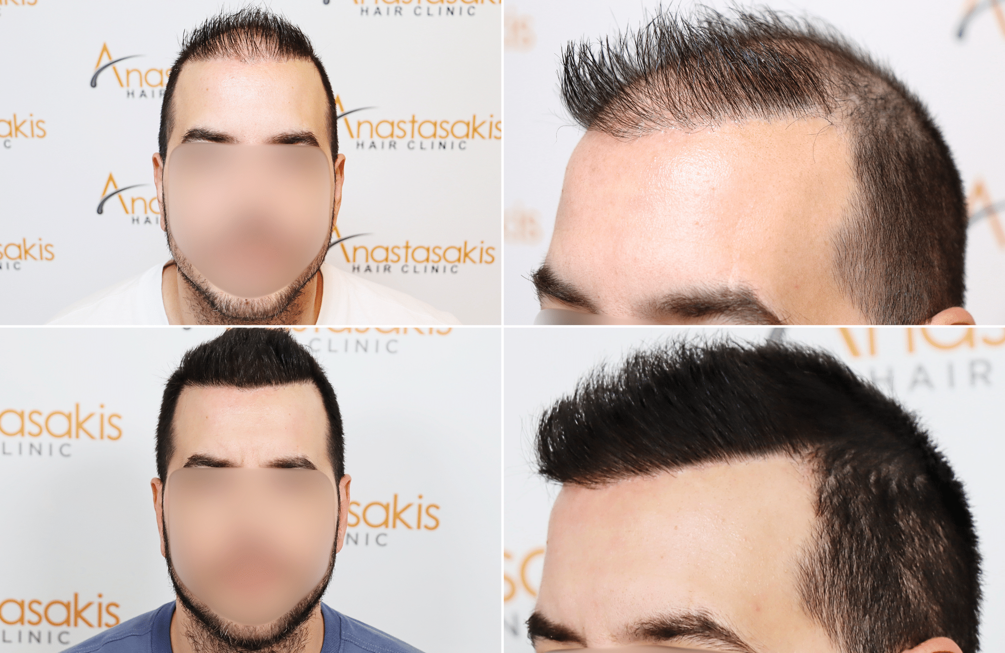https://www.anastasakishairclinic.gr/portfolio/apotelesma-metamosxefsis-mallion-anastasakis-hair-clinic-71/