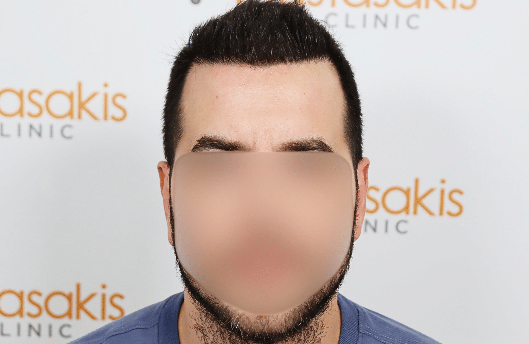 hai transplant result 2400 fus thick diffuse