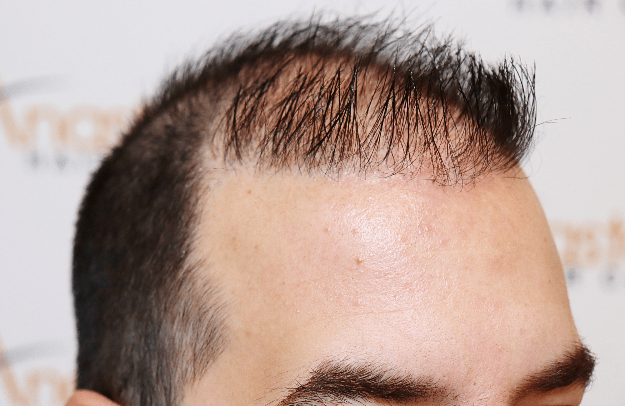 hai transplant result 2400 fus thick diffuse