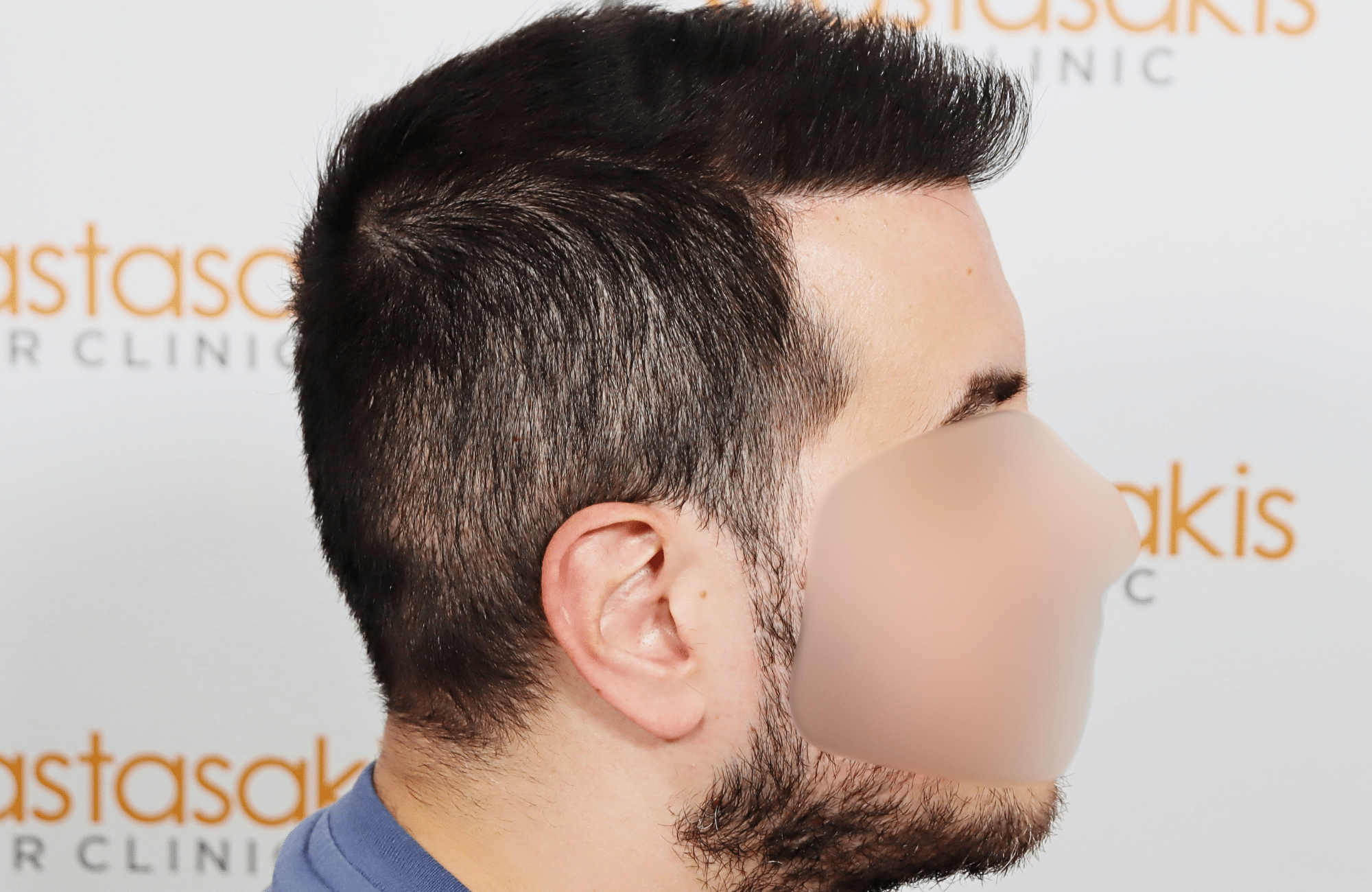 hai transplant result 2400 fus thick diffuse