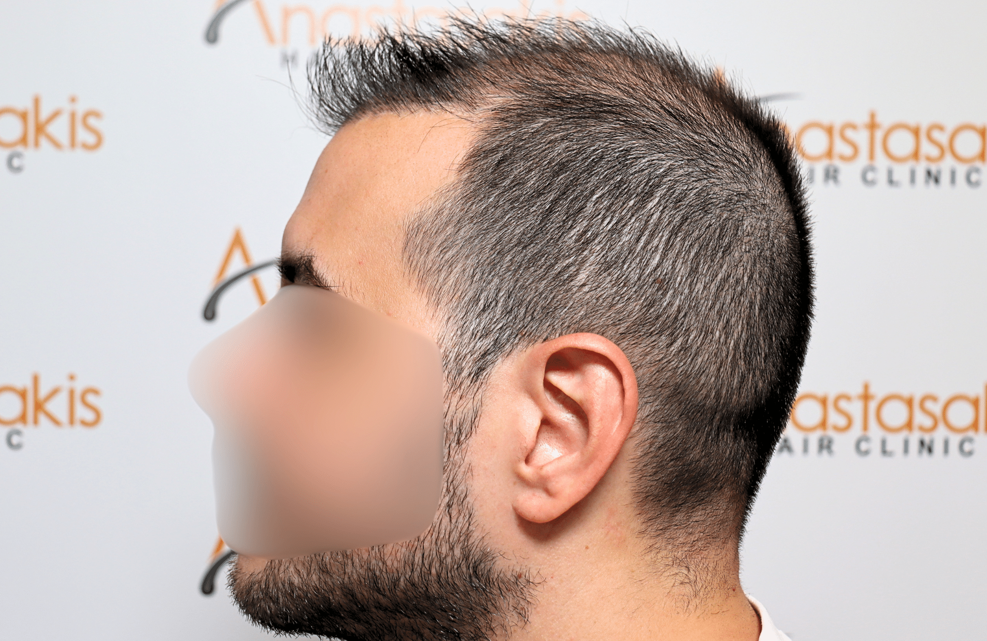 hai transplant result 2400 fus thick diffuse