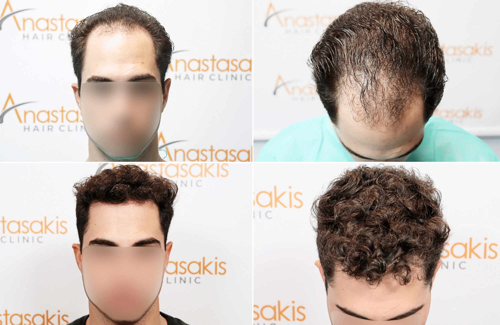 https://www.anastasakishairclinic.gr/portfolio/apotelesma-metamosxefsis-mallion-anastasakis-hair-clinic-142/