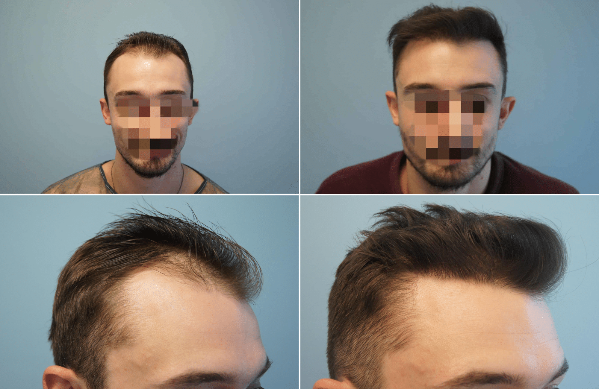 https://www.anastasakishairclinic.gr/portfolio/13monthslater-1300fus-with-fue/