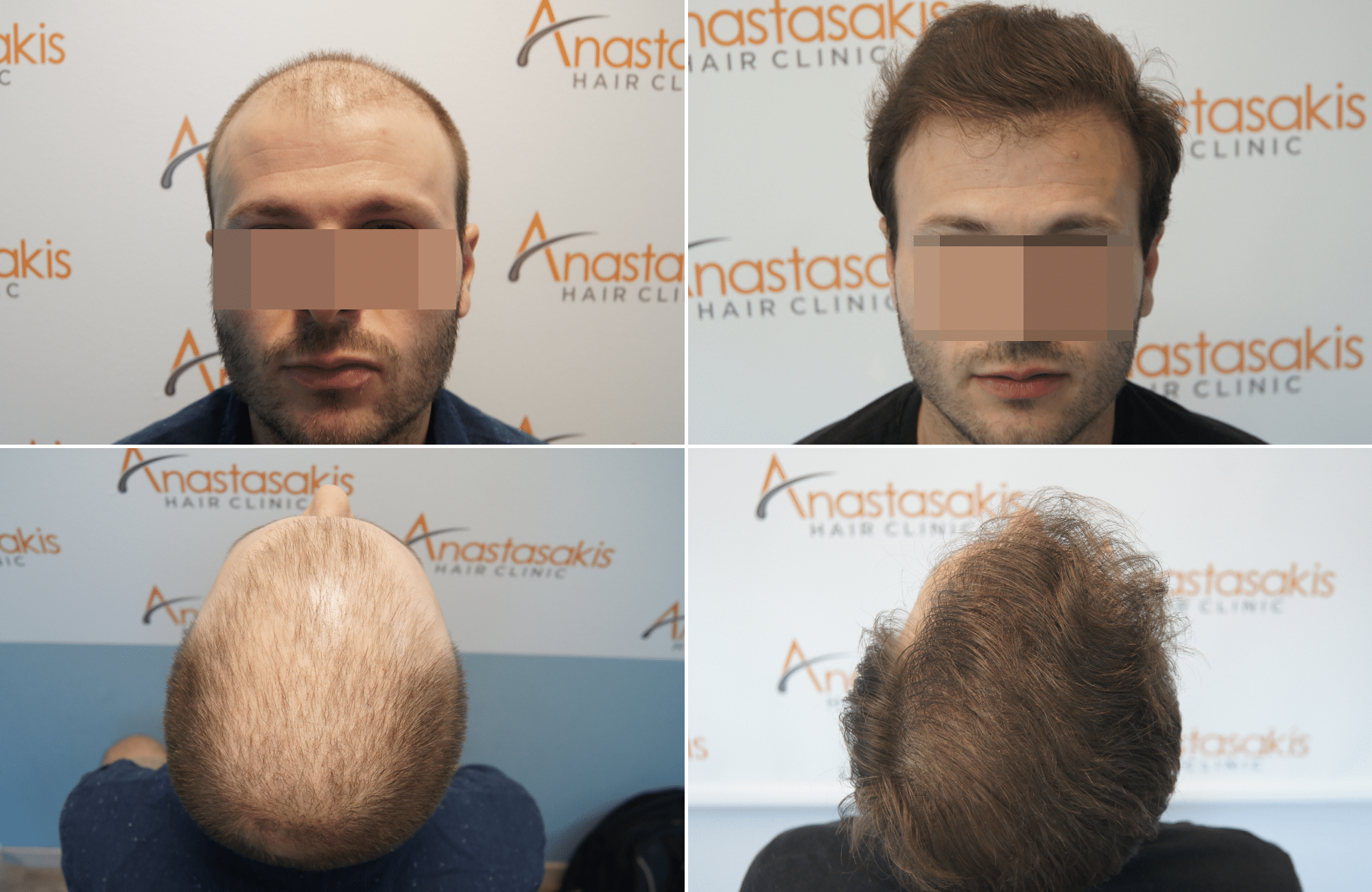 https://www.anastasakishairclinic.gr/portfolio/fue-2500-grafts-anastasakis-hair-clinic/
