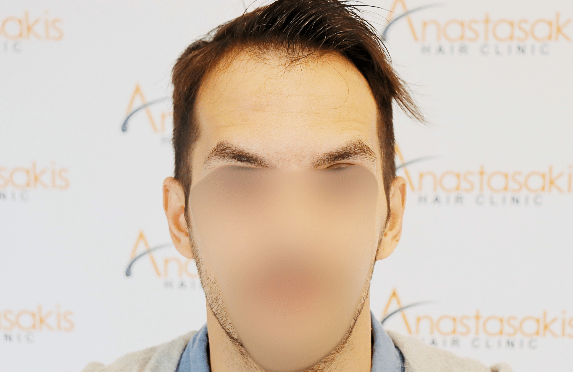 hair transplant result 2200 fus thick temples
