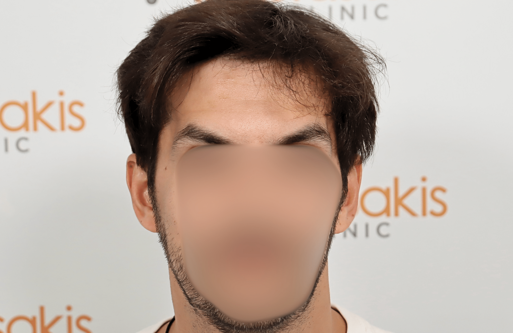 hair transplant result 2200 fus thick temples