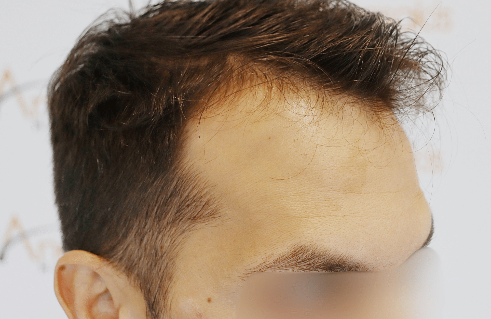 hair transplant result 2200 fus thick temples