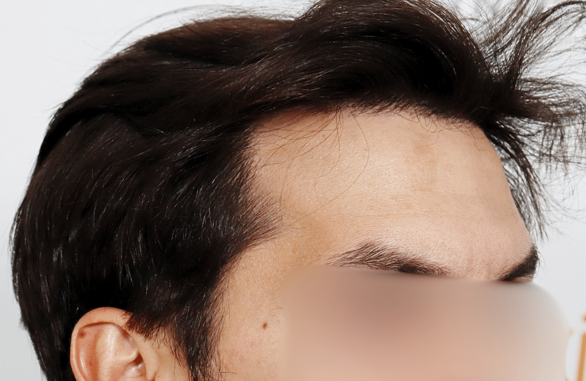 hair transplant result 2200 fus thick temples