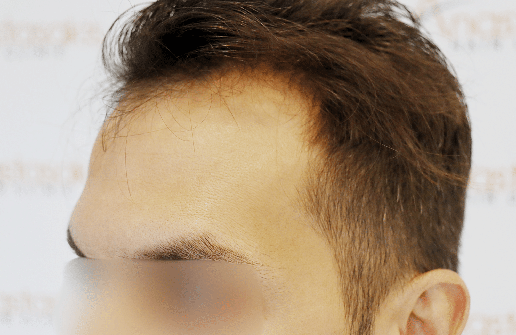 hair transplant result 2200 fus thick temples