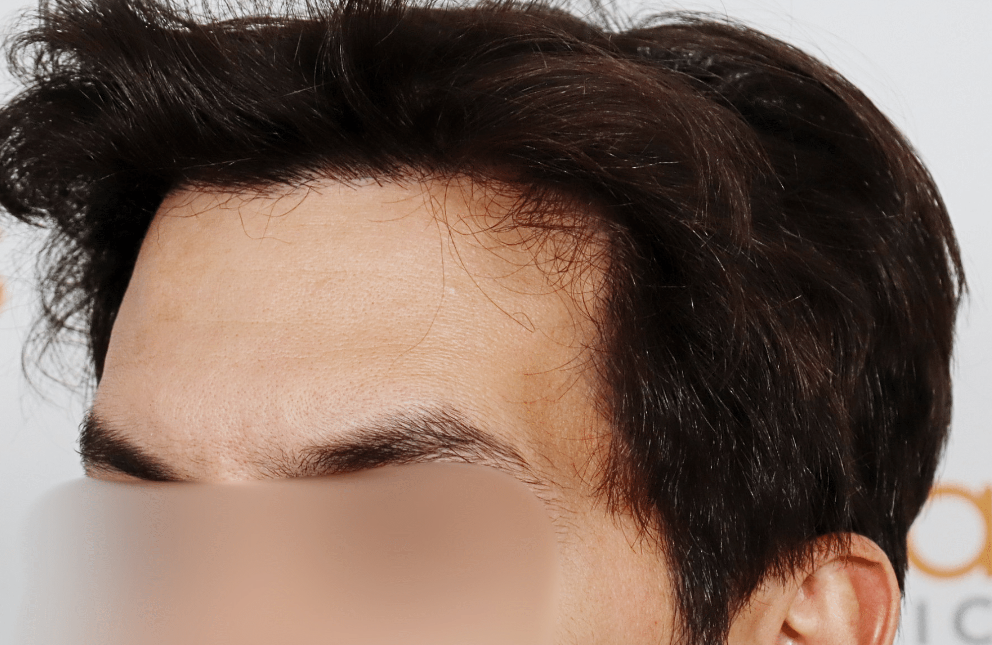 hair transplant result 2200 fus thick temples
