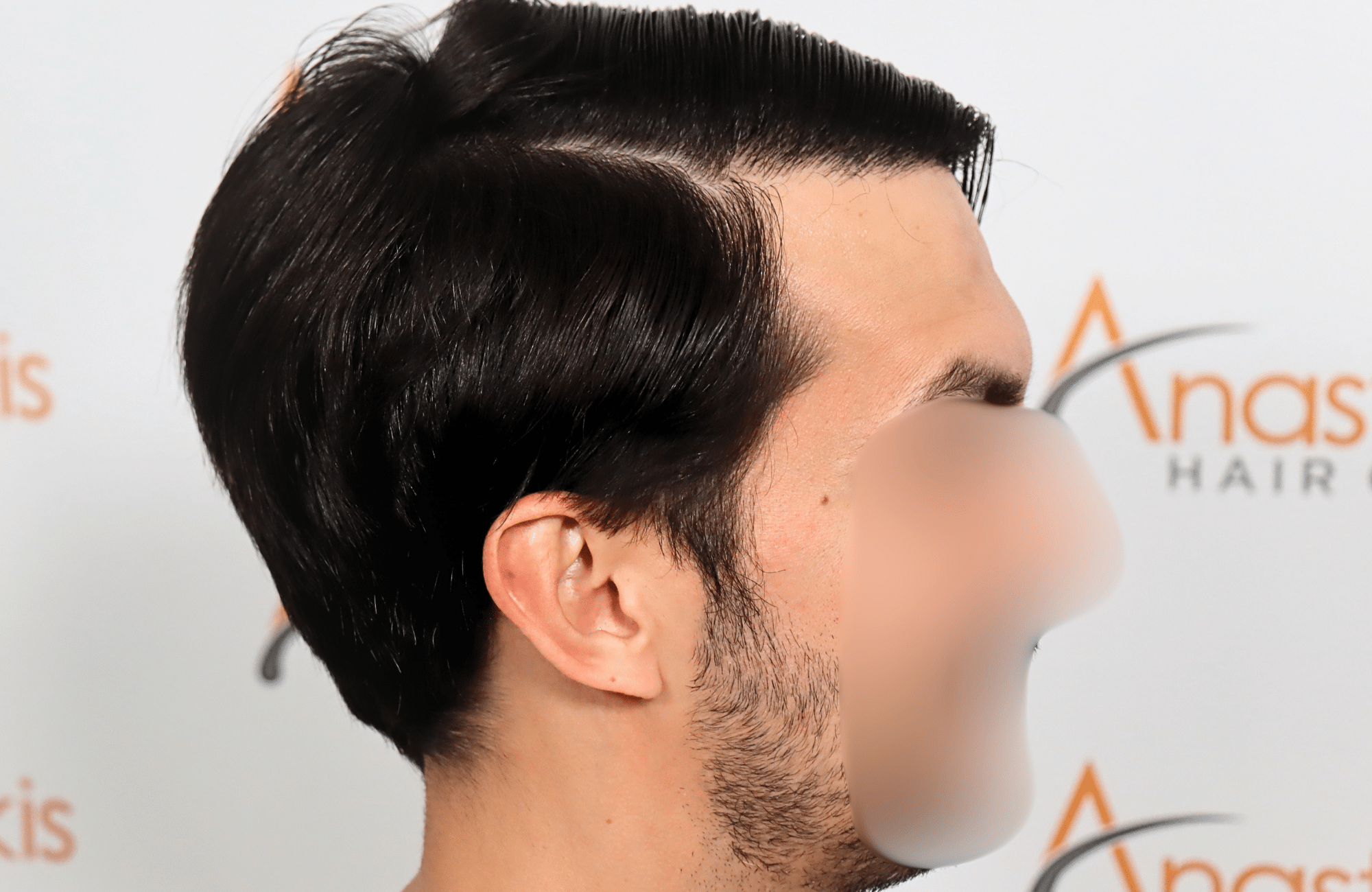 hair transplant result 2200 fus thick temples