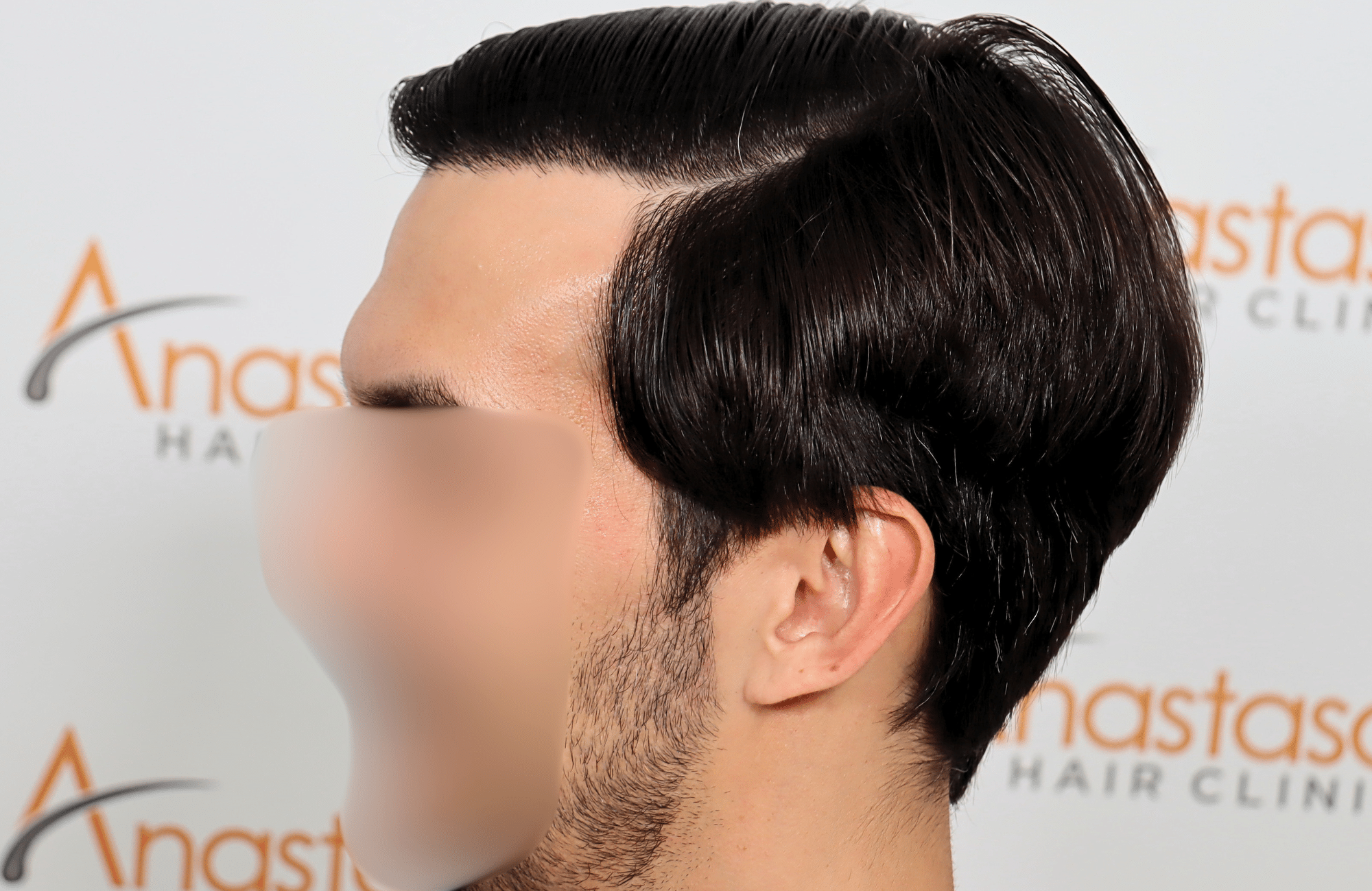 hair transplant result 2200 fus thick temples