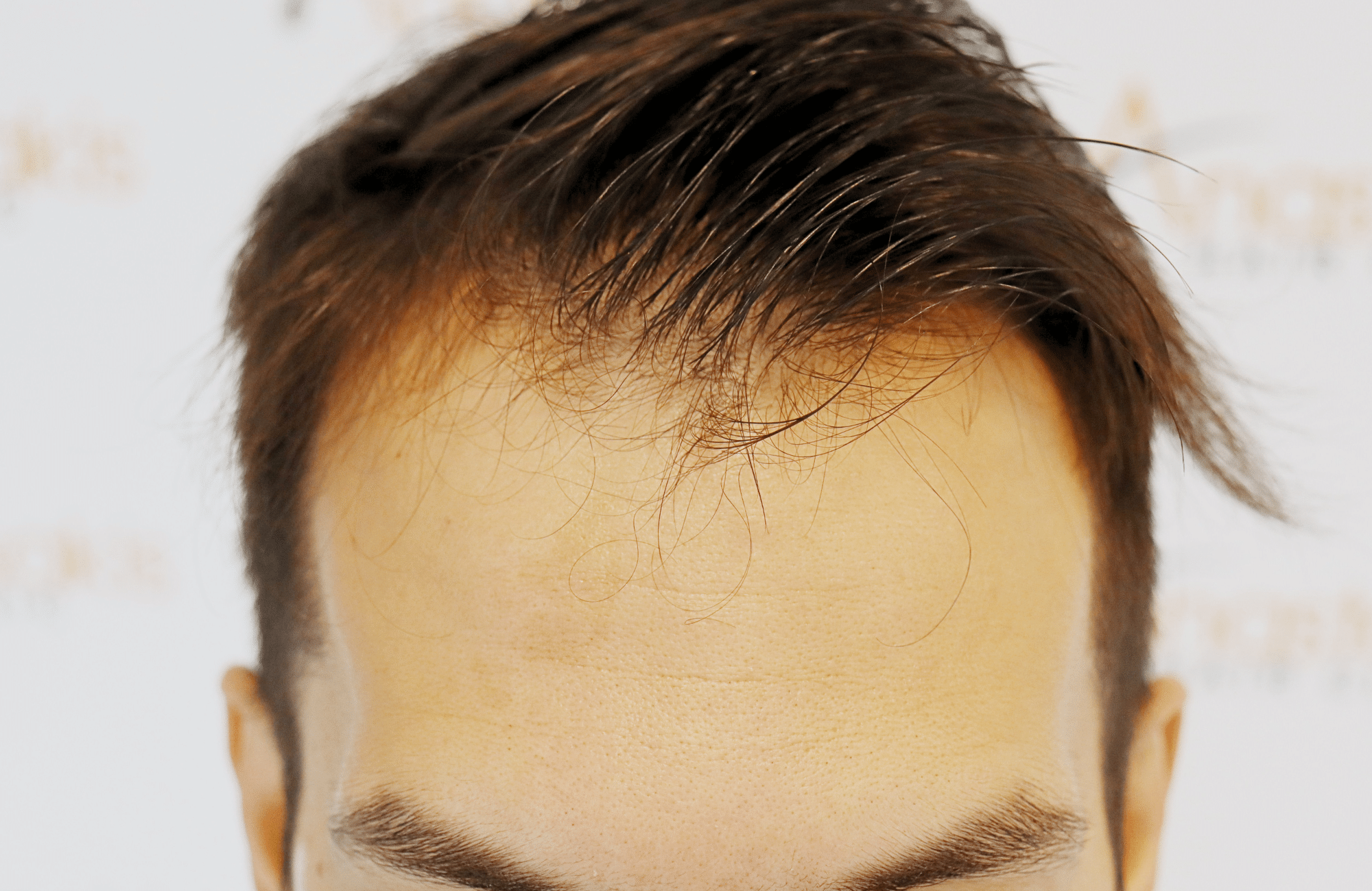 hair transplant result 2200 fus thick temples