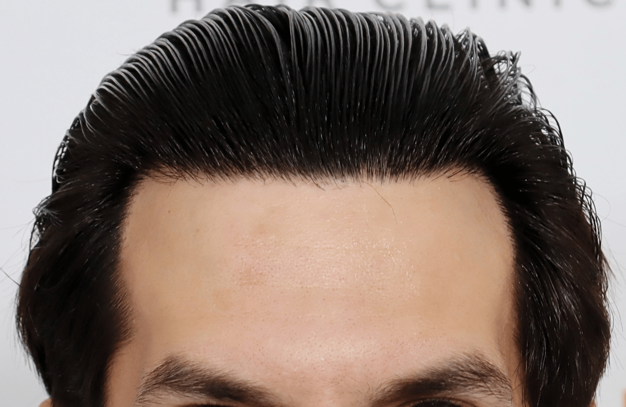 hair transplant result 2200 fus thick temples