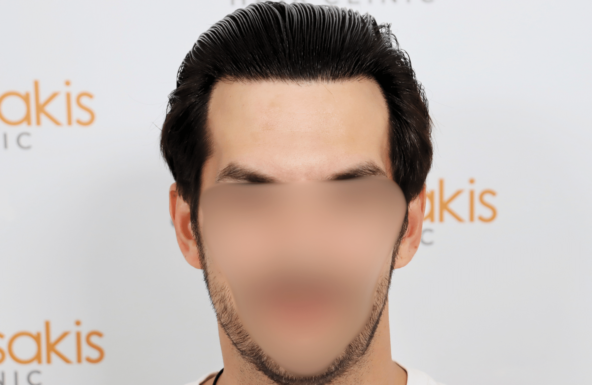 hair transplant result 2200 fus thick temples
