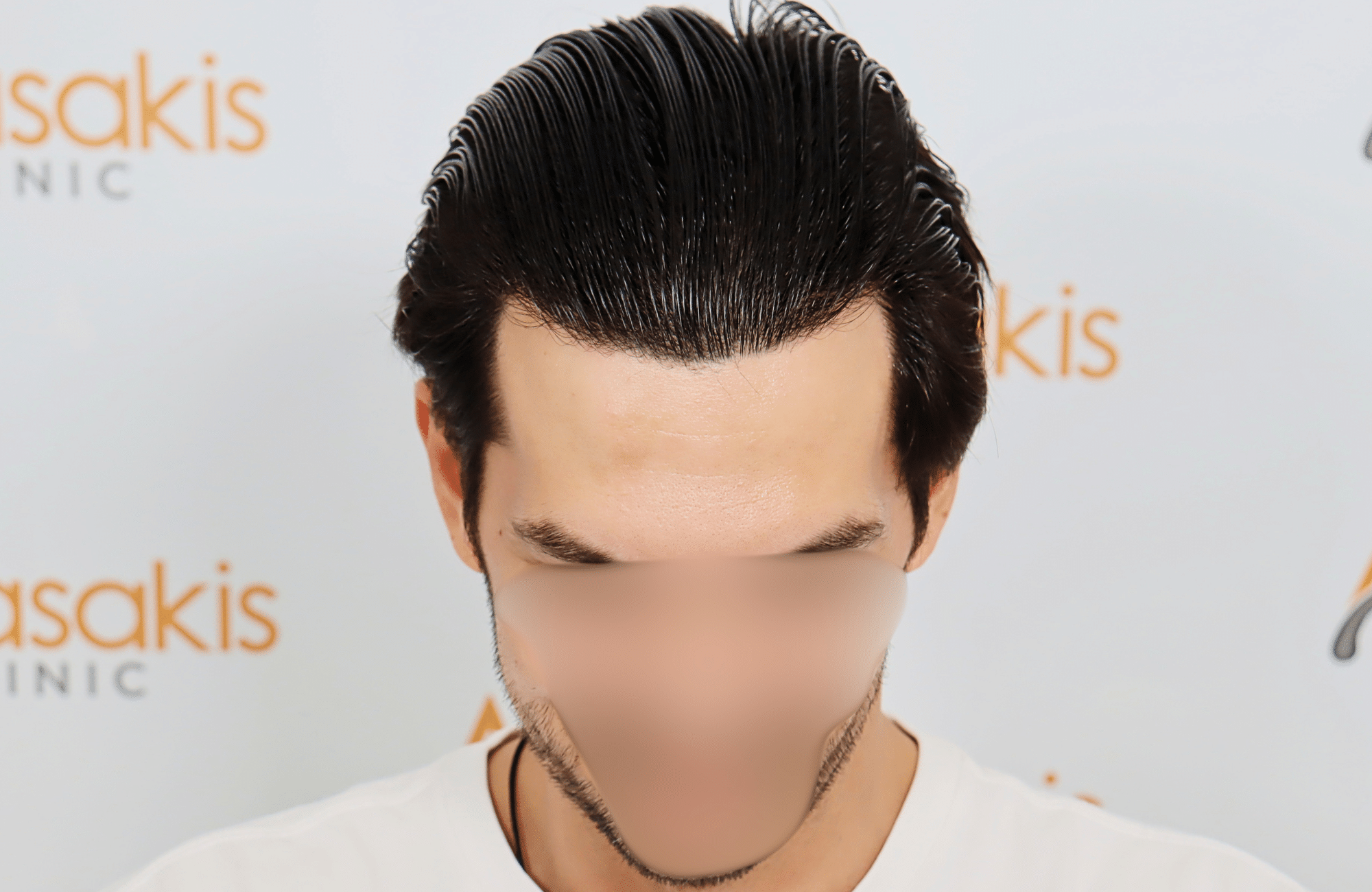 hair transplant result 2200 fus thick temples