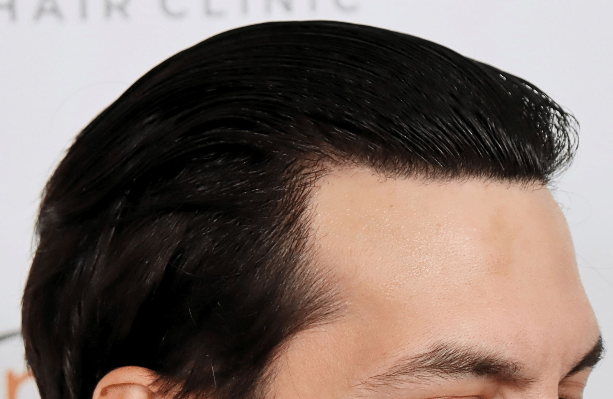hair transplant result 2200 fus thick temples