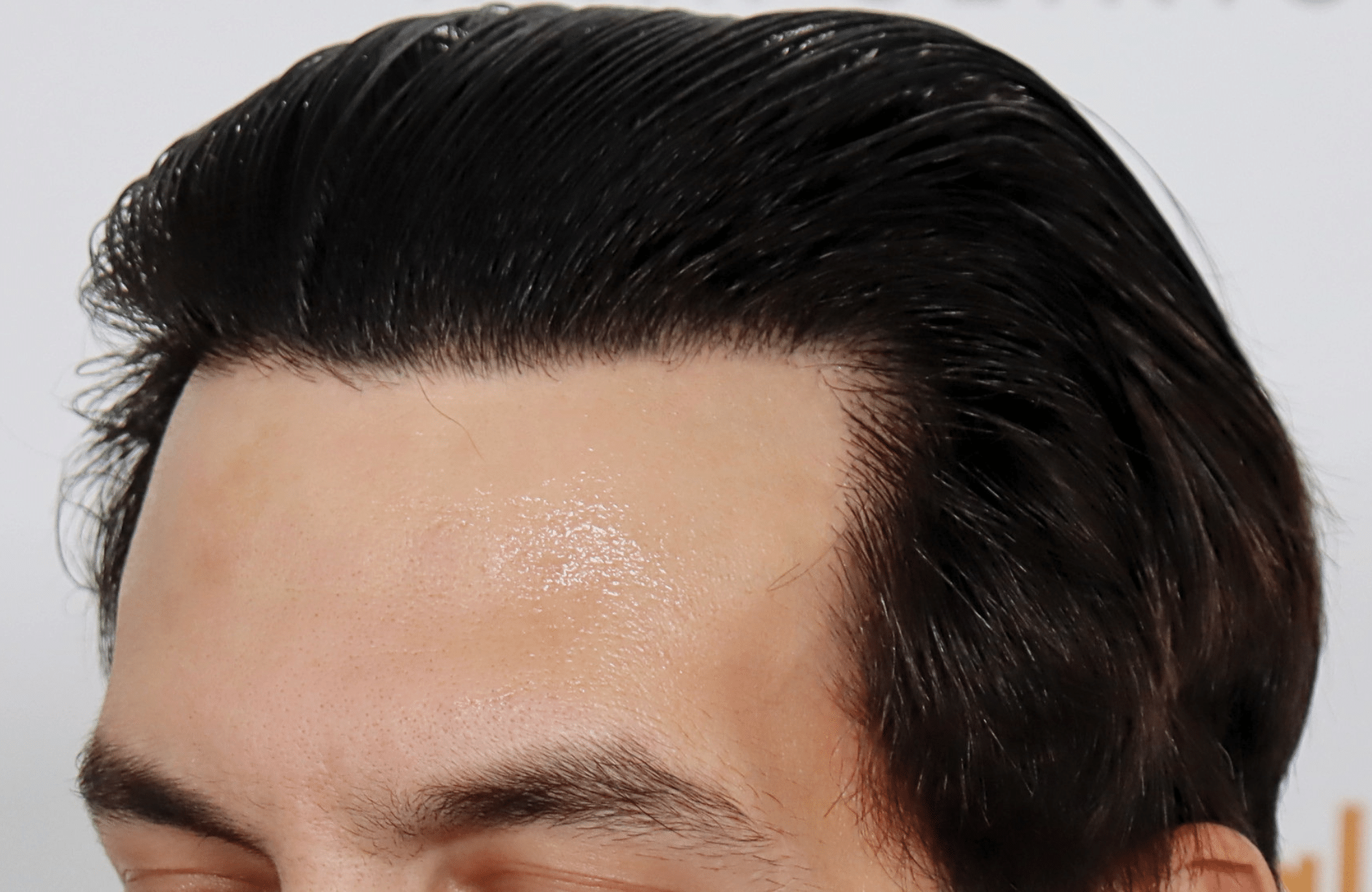 hair transplant result 2200 fus thick temples