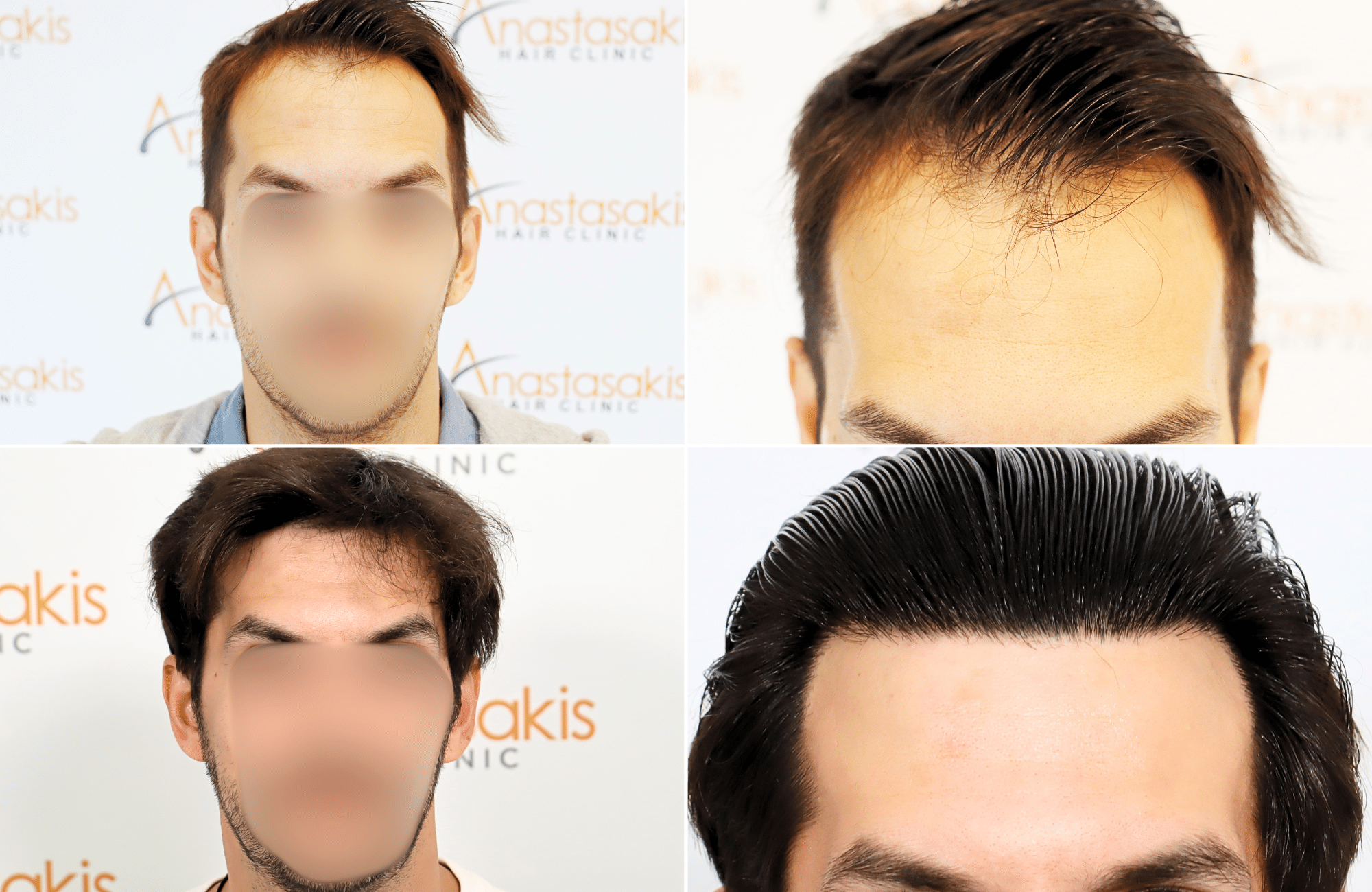 https://www.anastasakishairclinic.gr/portfolio/apotelesma-metamosxefsis-mallion-anastasakis-hair-clinic-155/