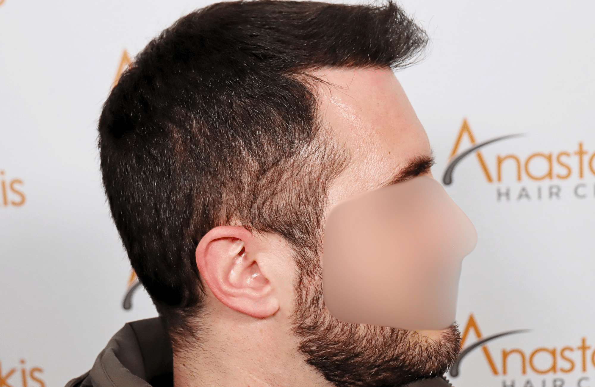 hair transplant result 2500 fus stage4