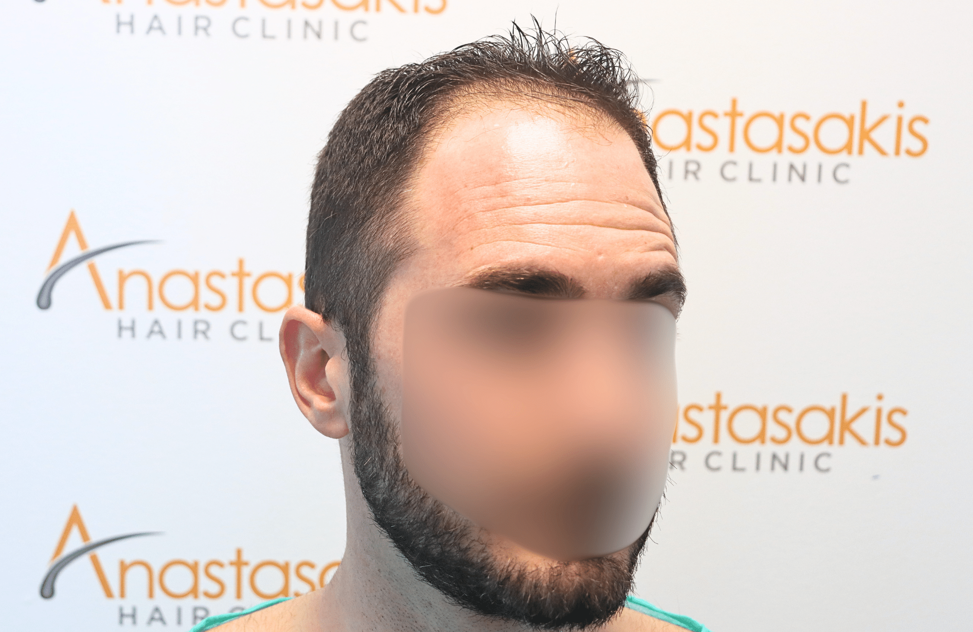 hair transplant result 2500 fus stage4