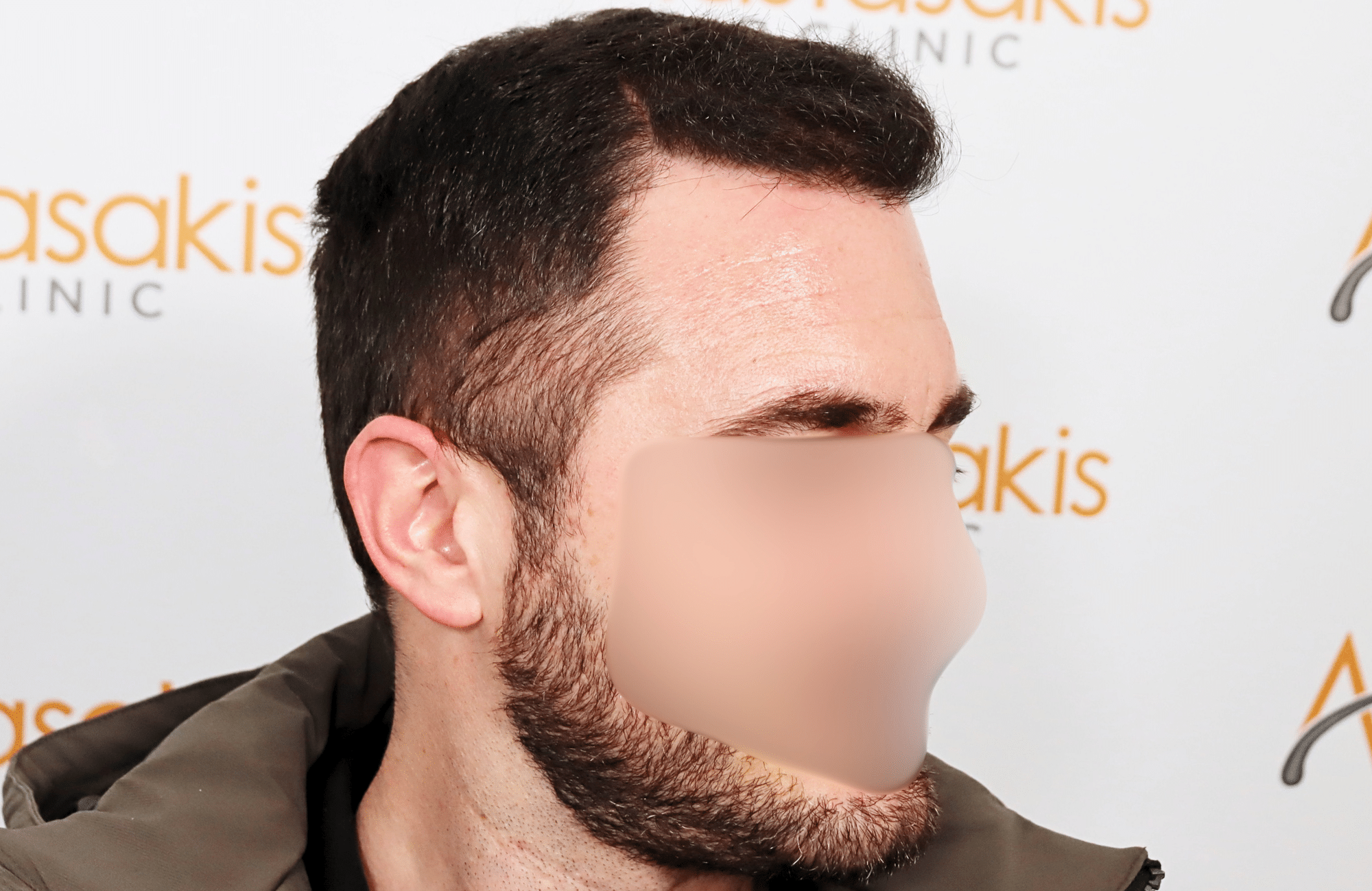 hair transplant result 2500 fus stage4